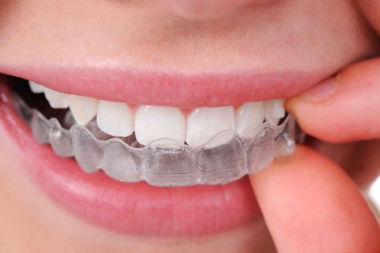 Ortodonzia invisalign Dr. Matteo Meneghel