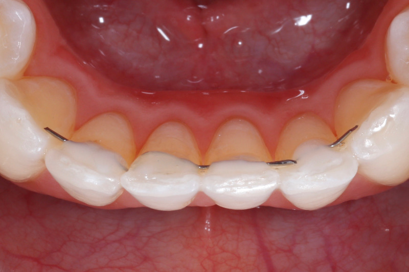 Ortodonzia linguale senza attacchi Dr. Matteo Meneghel
